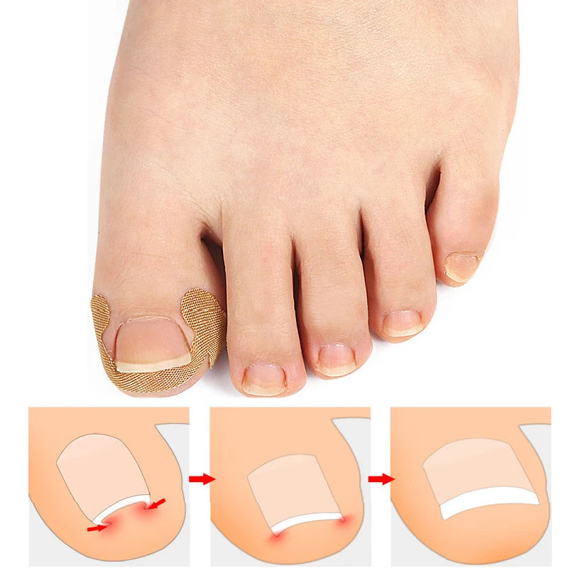 Ingrown Toenail Correction Sticker Adhesive Toenail Patch Foot Care Pedicure Kit Elastic Nail Corrector