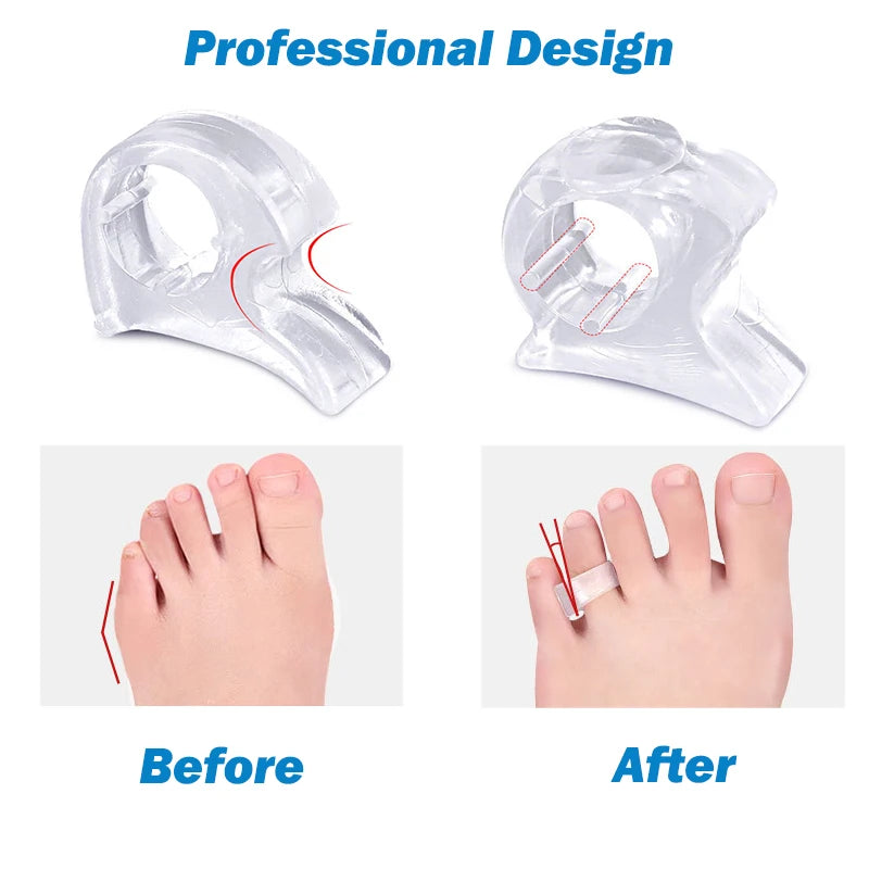 2Pcs/Pair Gel Toe Separators Spacers Bunion Corrector, Reduce Pain