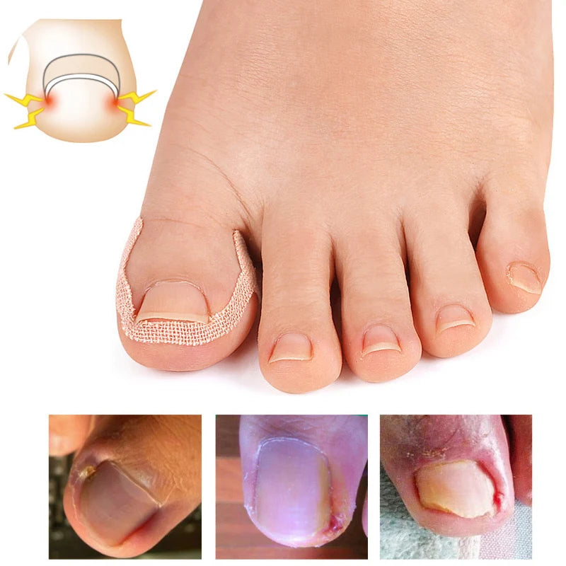 Ingrown Toenail Correction Sticker Adhesive Toe Nail Patch Foot Care Pedicure Tool Pain Relief Nail Corrector