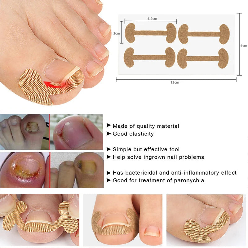 Ingrown Toenail Correction Sticker Adhesive Toenail Patch Foot Care Pedicure Kit Elastic Nail Corrector