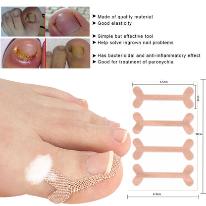 Ingrown Toenail Correction Sticker Adhesive Toe Nail Patch Foot Care Pedicure Tool Pain Relief Nail Corrector