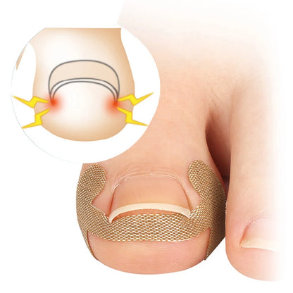 Ingrown Toenail Correction Sticker Adhesive Toenail Patch Foot Care Pedicure Kit Elastic Nail Corrector