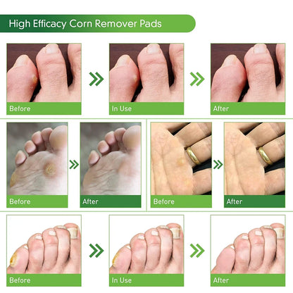 1/2/5/10Pcs Corn Remover Pads for Feet & Toes Fast-Acting Corn Treatment Foot Care Toe Protection Corn Removal Patches