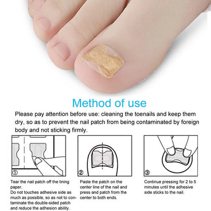 Ingrown Toenail Correction Sticker Foot Care Kit Toenail Corrector Pedicure Tool Toe nail Patch