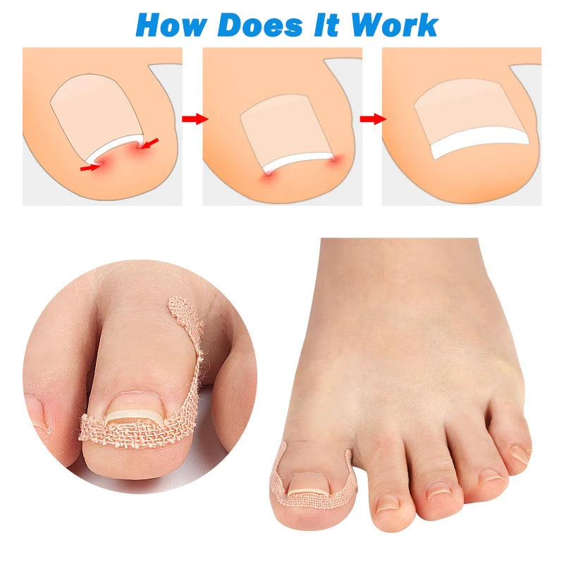 Ingrown Toenail Correction Sticker Adhesive Toe Nail Patch Foot Care Pedicure Tool Pain Relief Nail Corrector