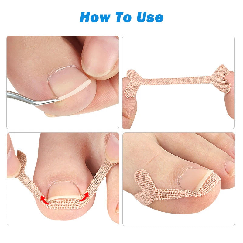 Ingrown Toenail Correction Sticker Adhesive Toe Nail Patch Foot Care Pedicure Tool Pain Relief Nail Corrector