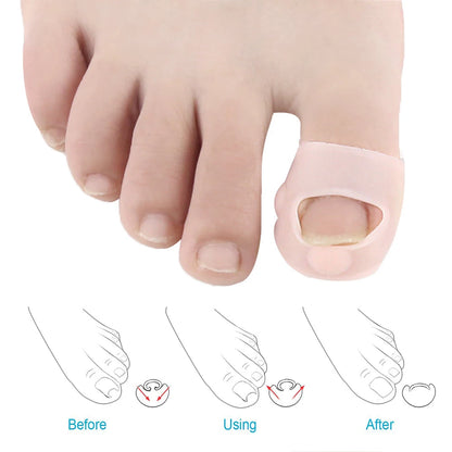 Ingrown Gel  Toenail Corrector Sleeves, Big Toe Nail Healing