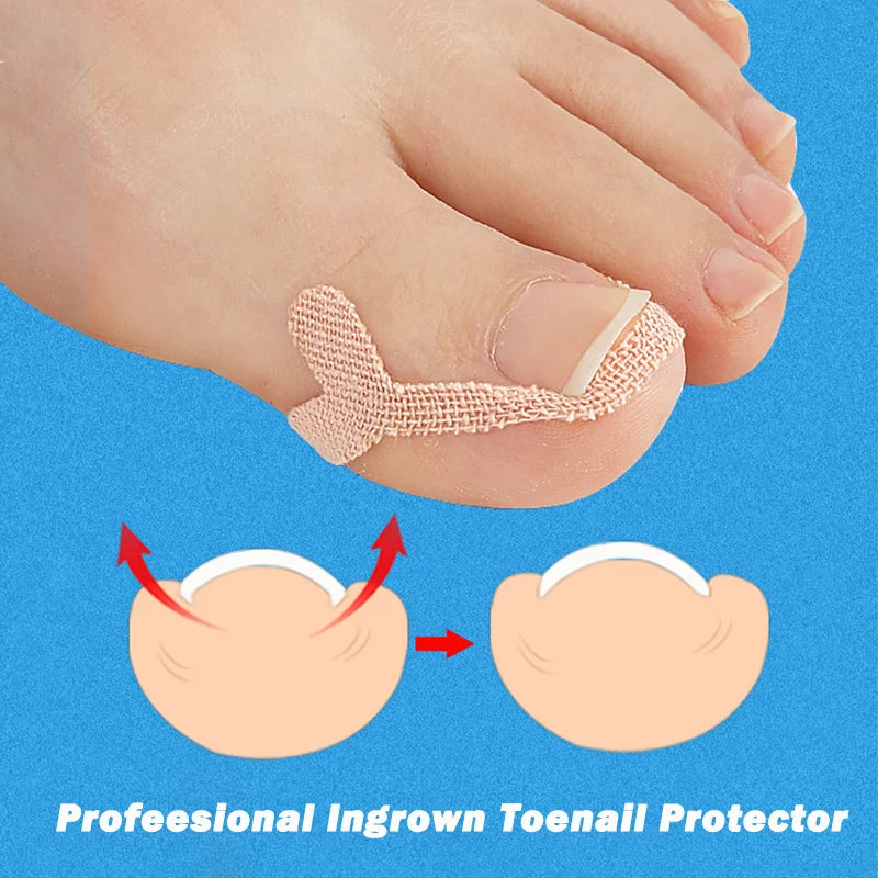 Ingrown Toenail Correction Sticker Adhesive Toe Nail Patch Foot Care Pedicure Tool Pain Relief Nail Corrector